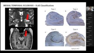 'Seizure related changes' By Dr. Domenico Tortora  from Gaslini Children's Hospital in Genova -Italy