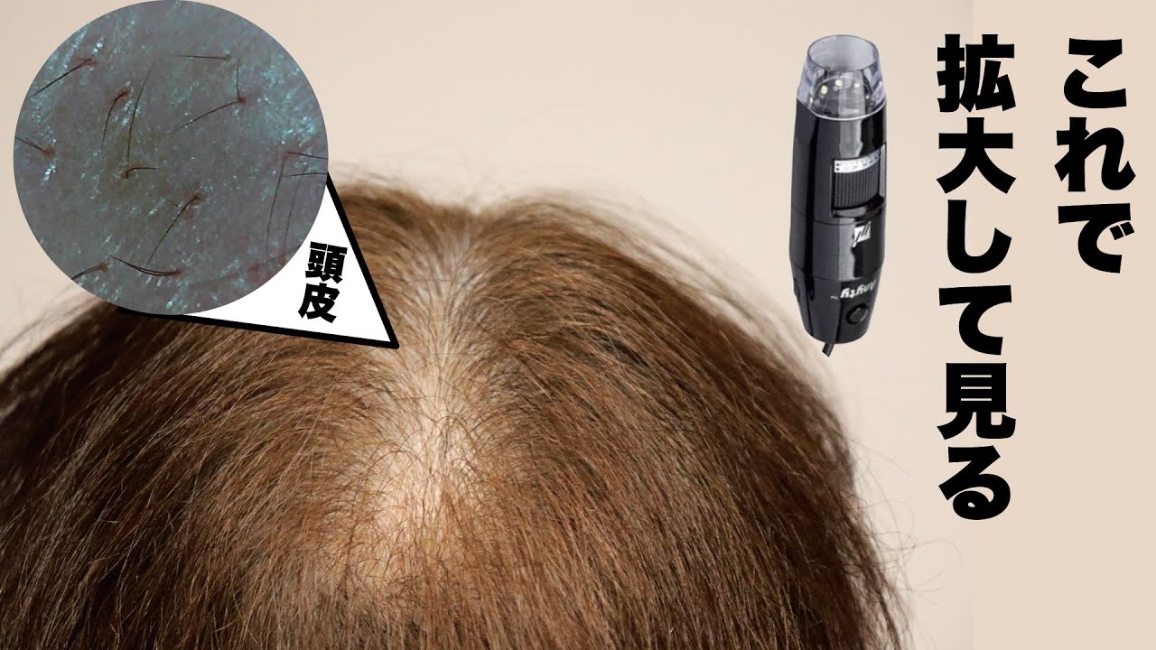 薄毛の人の頭皮をマイクロスコープで除いたら想像を軽く超えてきた