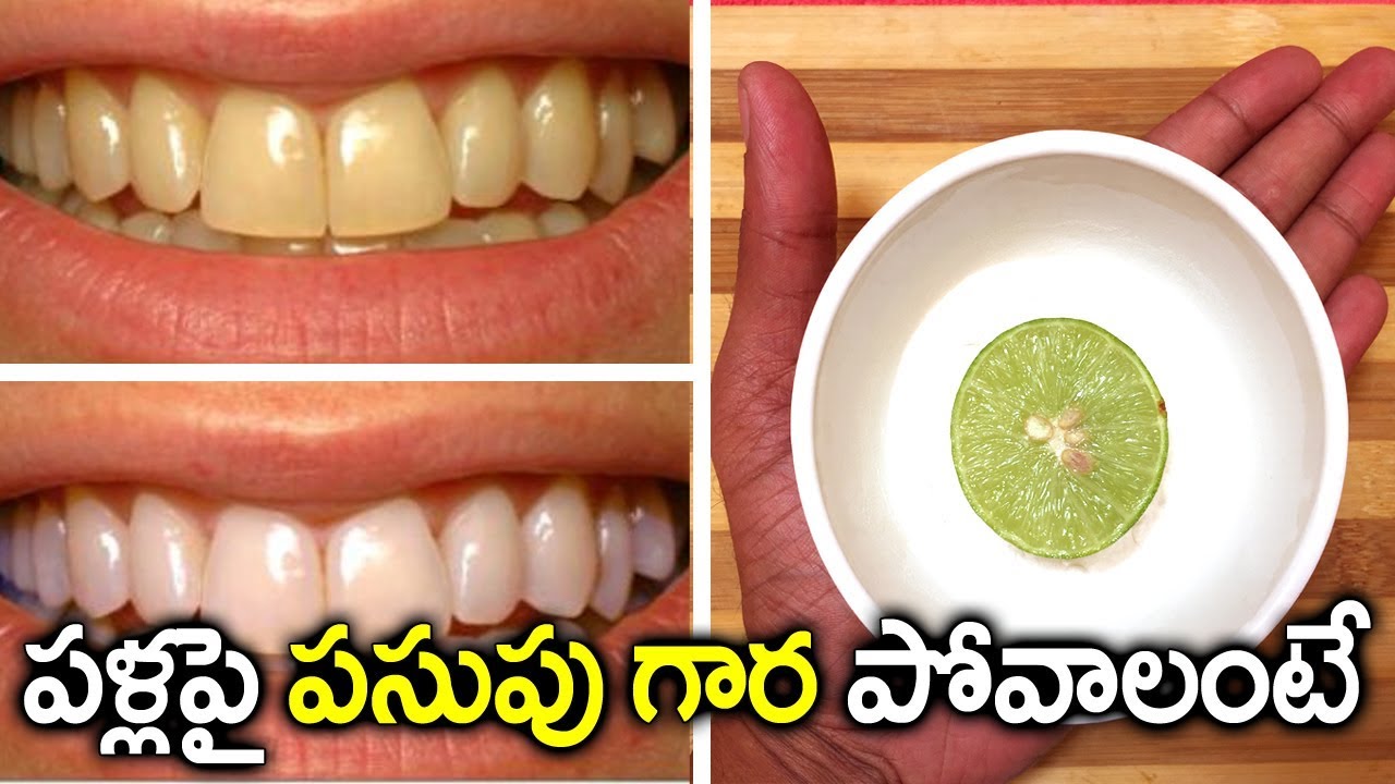 క్షణాల్లో పళ్ళపై పసుపు గార పోవాలంటే I Teeth Whitening Tips in Telugu I