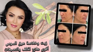 طريقة عمل زيت وخلاصة العرقسوس بمكون واحد فقط لعلاج الكلف+التصبغات الكلف تصبغاتالعرقسوس