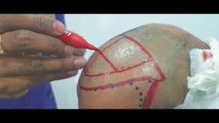 Hair Transplant Surgery Live Hair Transplant Surgeon In Hyderabad Microsurgclinics