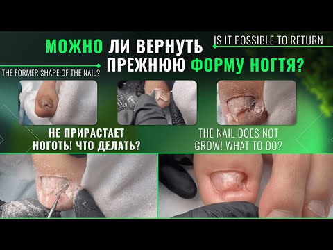 Не прирастает ноготь! Что делать? Можно ли вернуть прежнюю форму ногтя? @Podolog__eva