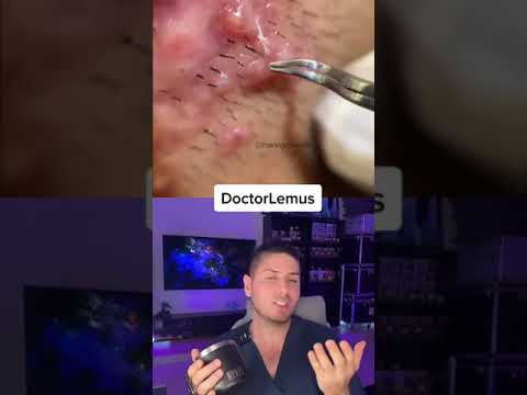 Video: 3 formas de deshacerse del vello de la nariz