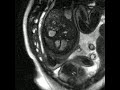 Fetal Heart Disease Visible for First Time on Real-Time MRI Scan for Expectant Mothers