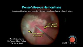 RetinaRounds™ 188: Dense Vitreous Hemorrhage