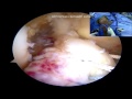 Dr christopher s ahmad  anterior cruciate ligament repair