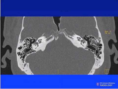 Head and Neck Radiology Teaching case 14.wmv
