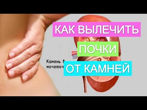 Камни в почках. Симптомы, причины появления и лечение камней в почках.