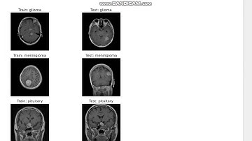 DUAL MODULE MRI IMAGE ENHANCEMENT AND TUMOR CLASSIFICATION FOR OPTIMIZED BRAIN TUMOR DETECTION