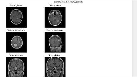 DUAL MODULE MRI IMAGE ENHANCEMENT AND TUMOR CLASSIFICATION FOR OPTIMIZED BRAIN TUMOR DETECTION