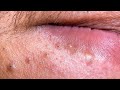[ASMR] Blackheads and Whiteheads Removal | Deep Pore Cleansing