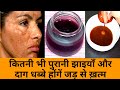 कितनी भी पुरानी झाईयाँ, Pigmentation, दाग-धब्बे,मुहॉंसे पिम्पल्स जड़ से ख़त्म, 100% रिजल्ट