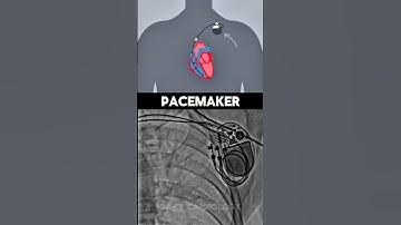 Permanent Pacemaker #shorts #cardiology #pacemaker #hearthealth