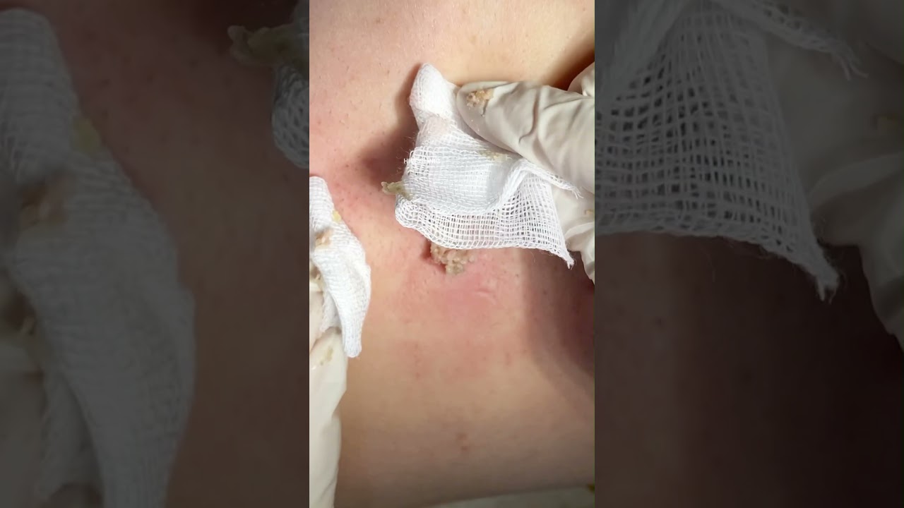 Nặn mụn u nang bã ở lưng PART 2.