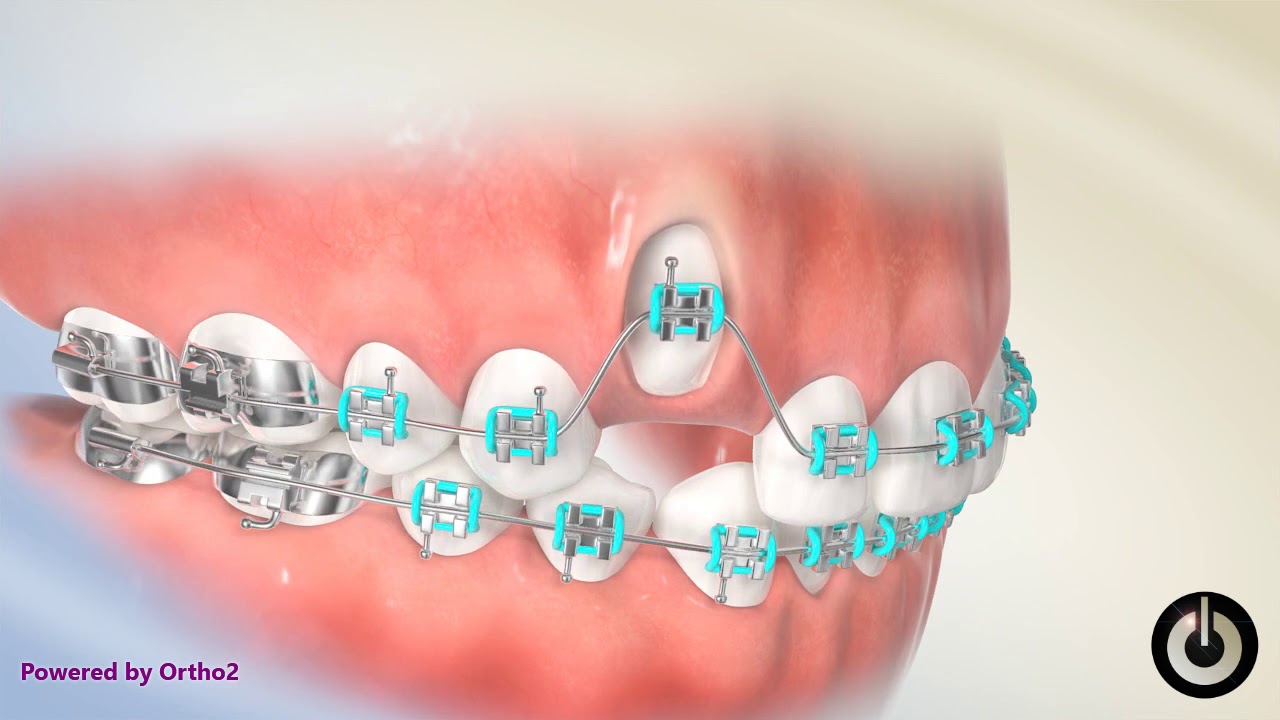 Laser Exposure of Canine Dental Braces Temecula Valley, CA YouTube