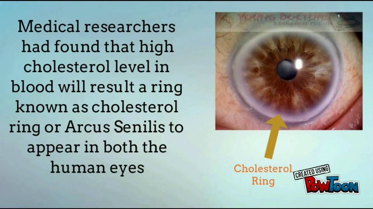 High Cholesterol In Women: Signs That May Show Up In Your Eyes