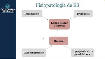 ¿Puede la esclerodermia afectar al corazón?