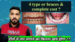 दाँतो में तार लगाने का खर्च  Braces 4 types and cost |