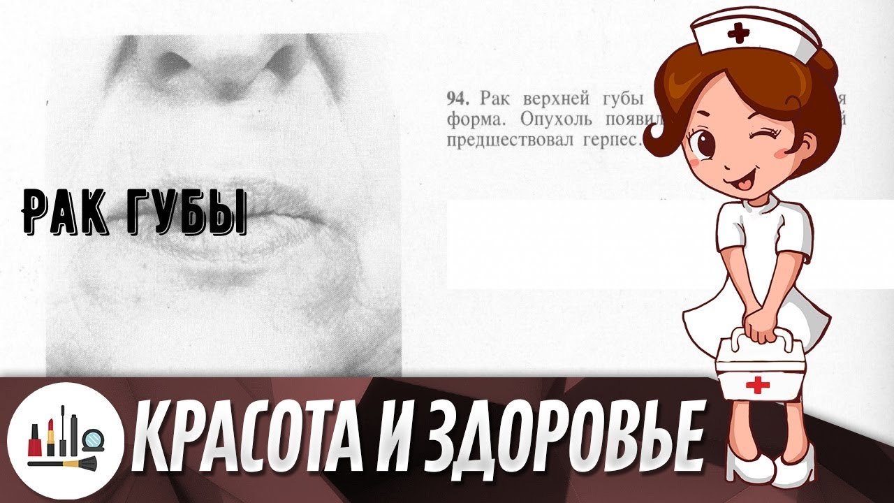 Рак губы