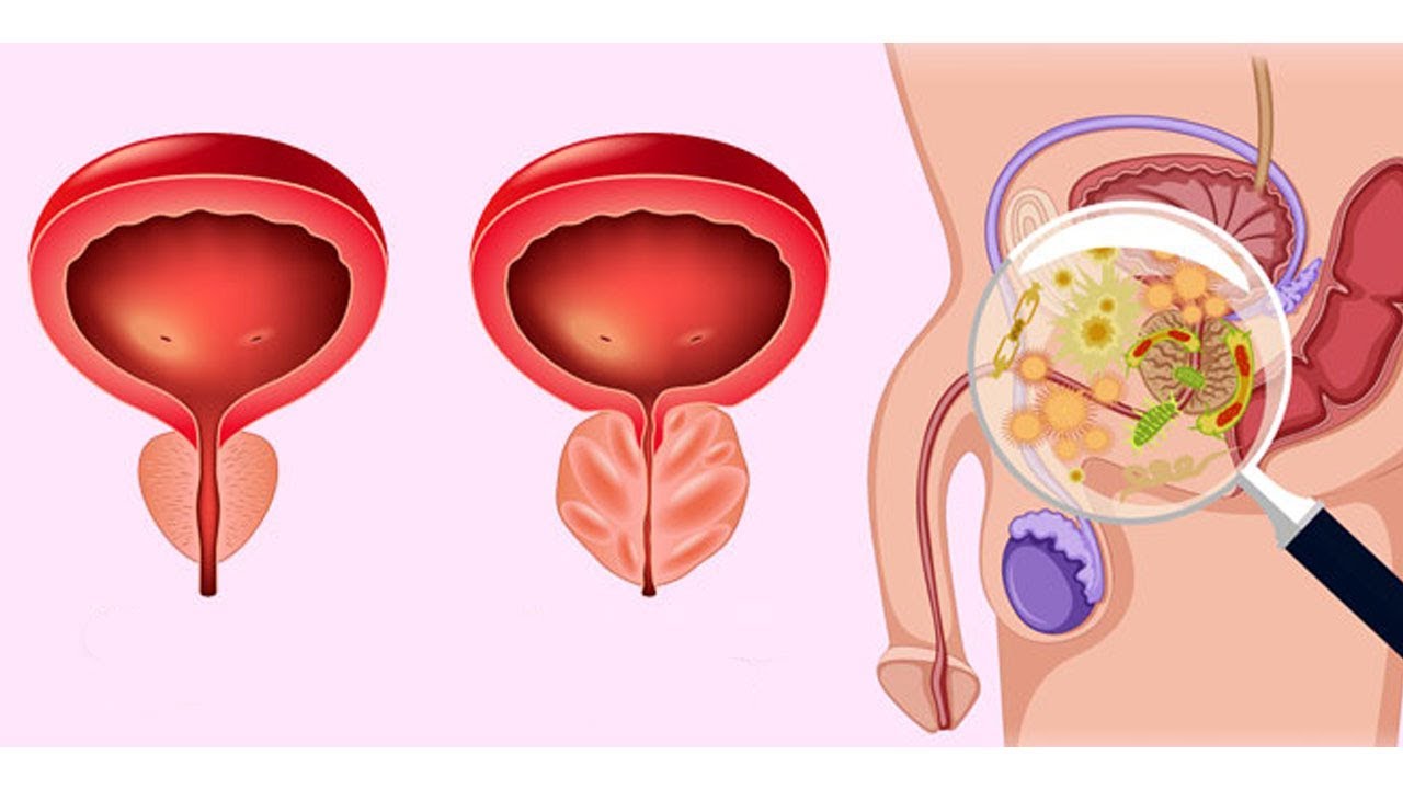 Повышенная простата. Повышенная простата. Простатит предстательной железы. Повышенная простата. Аденома предстательная железа у мужчин.