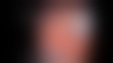 Biliary metal stenting by Prof  Uday C Ghoshal