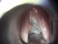 The Best Way to Remove Vocal Cord Polyp