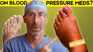 Blood Pressure Med Side Effects And Easy Fixes