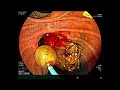 "ERCP - LARGE SQUARE SHAPED CBD STONE"