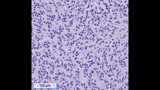 Challenging Cases in Soft Tissue Pathology: Dr. Paari Murugan, University of Minnesota screenshot 5