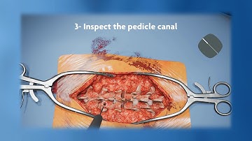 Sim-Ortho VR training simulator -  Spinal Fusion procedure