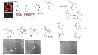 Left coronary engagement (radial focus): detailed steps, diagrams, tips, and case videos-Elias Hanna