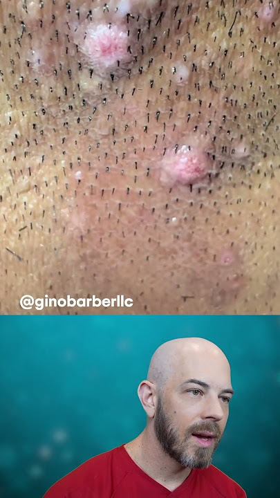 If your scalp looks like this, don't pluck! 🚫 (credit: @ginobarberllc on TT) #ingrown #plucking