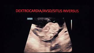 Download Lagu 16 week complex cardiac anomaly-Situs inversus,dextrocardia,partial AVSD,TG -Dr Pradeep srinivasan. MP3 Download Lagu 16 week complex cardiac anomaly-Situs inversus,dextrocardia,partial AVSD,TG -Dr Pradeep srinivasan. MP3