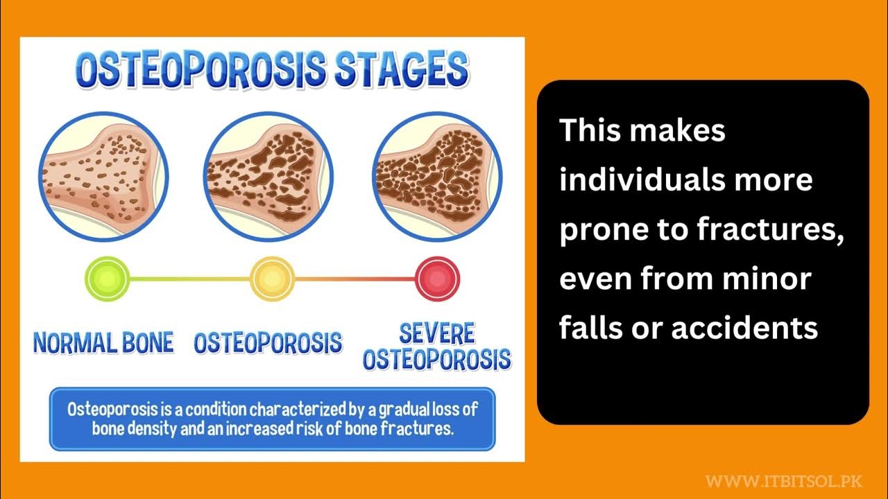 osteoporosis-a-silent-killer-youtube