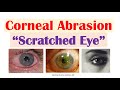 Corneal Abrasion (“Scratched Eye”) | Causes, Signs & Symptoms, Diagnosis, Treatment