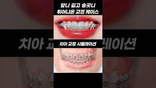 앞니 길고 송곳니 튀어나온 교정 케이스