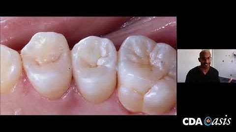 Dr. Sunny Virdi  discusses how to get good proximal contacts (Part 2)