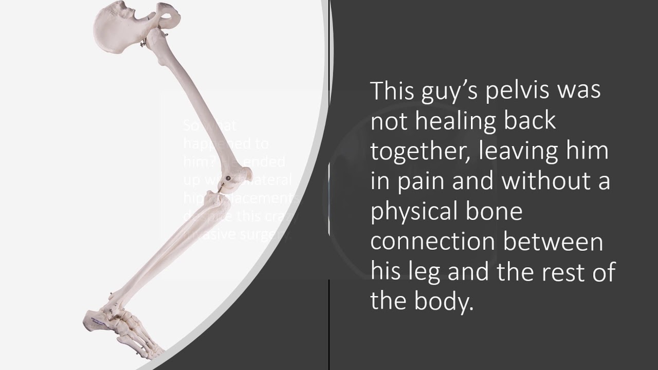 Hip PAO Surgery Complications YouTube