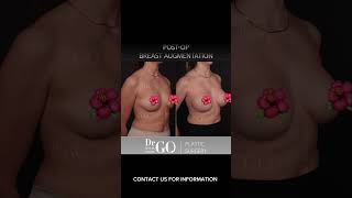 Before and After Rhinoplasty - Dr Guncel Ozturk #drgo #guncelozturk #breastaugmentationsurgery
