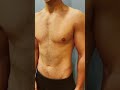 Gynecomastia Gland Removal Surgery 24 year Old Male from VIRGINIA 💪🏼