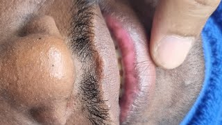 Best Micropigmentation Treatment for white inner lips area. Contact: 970002-0802