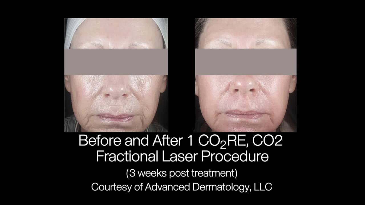 CO2RE Лазерная шлифовка