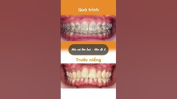 Hành trình LỘT XÁC nhờ niềng răng của Trần Thị Lương