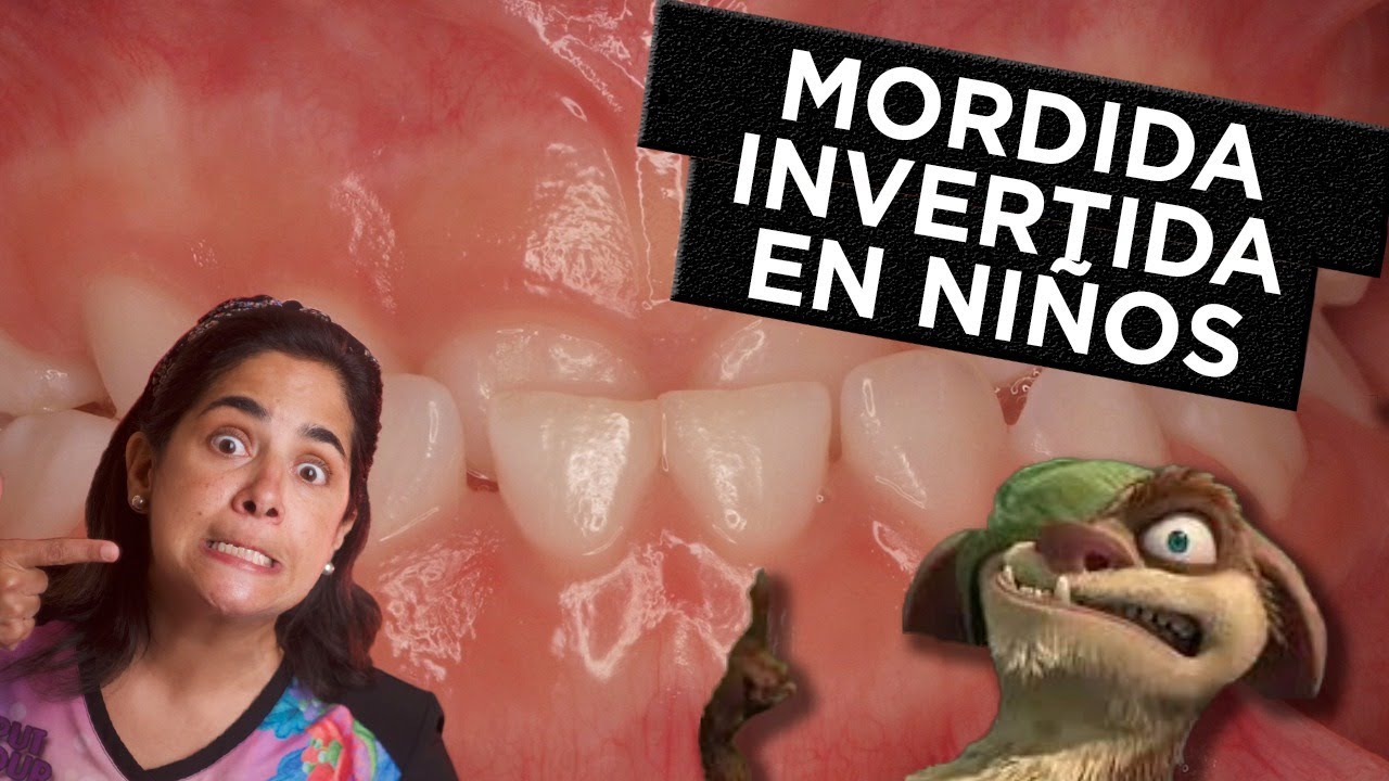 Mordida Invertida: ¿Se Corrige? ¿Cómo?