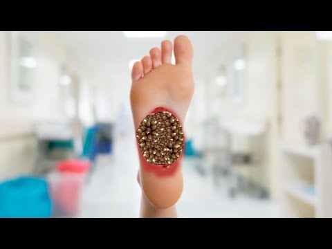 dog tick removal
