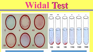 التشخيص المعملى لحمى التيفوئيد Lab Diagnosis of Typhoid Fever