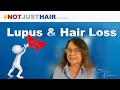 Lupus & Hair Loss. Symptoms, Prevention and Treatment