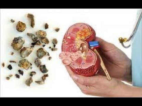 3 natural ingredients that are effective in treating kidney stones