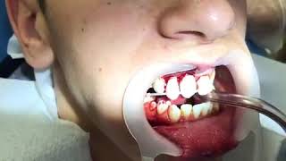 Dental Trauma - Fixing Tooth Intrusion &amp; Avulsion