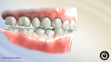 Curve of Spee Correction   TAD, Lower